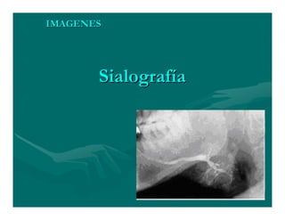 Sjögren Sindrome de