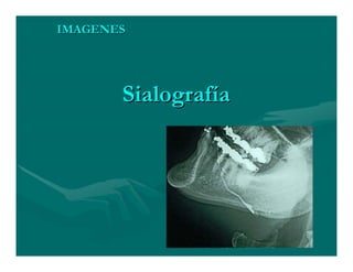 Sjögren Sindrome de