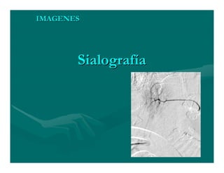 Sjögren Sindrome de