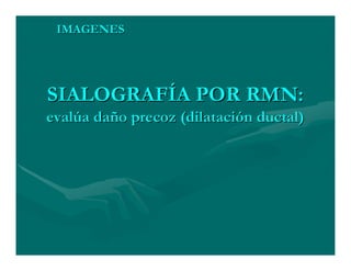 Sjögren Sindrome de