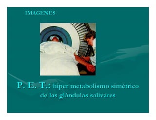 Sjögren Sindrome de