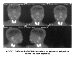 Sjögren Sindrome de