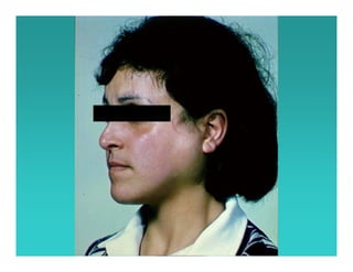 Sjögren Sindrome de