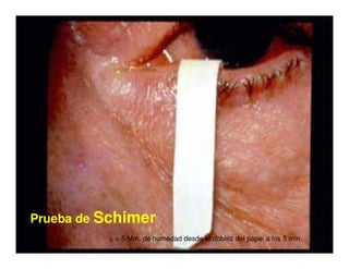 Sjögren Sindrome de