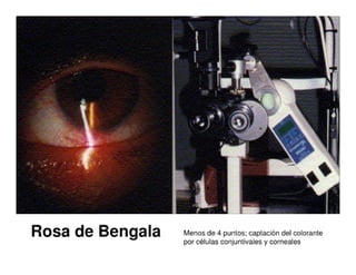 Sjögren Sindrome de