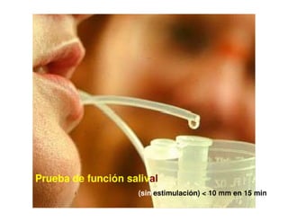 Sjögren Sindrome de