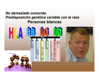 Sjögren Sindrome de