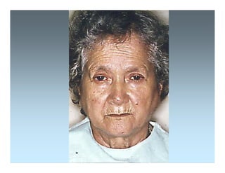 Sjögren Sindrome de