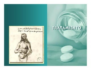 Sjögren Sindrome de