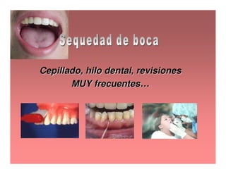 Sjögren Sindrome de