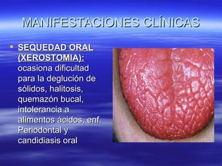MANIFESTACIONES CLÍNICAS
 SEQUEDAD ORAL
  (XEROSTOMIA):
  ocasiona dificultad
  para la deglución de
  sólidos, halitosis,
  quemazón bucal,
  intolerancia a
  alimentos ácidos, enf.
  Periodontal y
  candidiasis oral
 