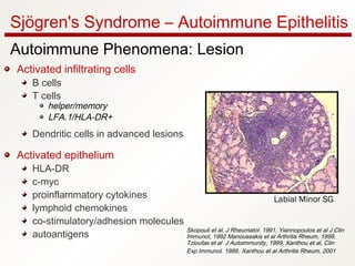 Sjögren's Syndrome – Autoimmune Epithelitis
Autoimmune Phenomena: Lesion
Activated infiltrating cells
B cells
T cells
helper/memory
LFA.1/HLA-DR+
Dendritic cells in advanced lesions
Activated epithelium
HLA-DR
c-myc
proinflammatory cytokines
lymphoid chemokines
co-stimulatory/adhesion molecules
autoantigens
Skopouli et al, J Rheumatol. 1991, Yiannopoulos et al J Clin
Immunol, 1992 Manoussakis et al Arthritis Rheum, 1999,
Tzioufas et al J Autoimmunity, 1999, Xanthou et al, Clin
Exp Immunol. 1999, Xanthou et al Arthritis Rheum, 2001
Labial Minor SG
 