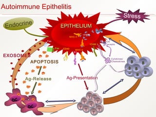 EPITHELIUMEPITHELIUM
Endocrine
StressStress
Autoimmune Epithelitis
EXOSOMES
DC
DC
Ag-Release
T
T
T
T
T
T
T
T
T
Ag-Presentation
B
B
B
B
BB
EPITHELIUMEPITHELIUM
Persistent Virus
Genetic Make-up
CD40
APOPTOSIS
Fas
Fas
L
B7
T
B
Cytokines/
Chemokines
ICAM.1
CK
recepto
r
EPITHELIUMEPITHELIUM
La/SSB
La/SSB
MHC-II
MHC-II
 