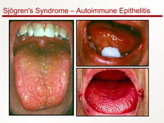 Sjögren's Syndrome – Autoimmune Epithelitis
 