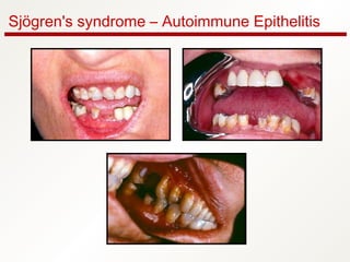 Sjögren's syndrome – Autoimmune Epithelitis
 