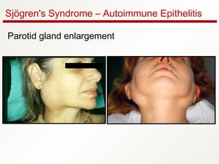 Sjögren's Syndrome – Autoimmune Epithelitis
Parotid gland enlargement
 