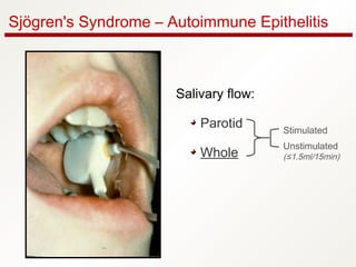 Sjögren's Syndrome – Autoimmune Epithelitis
Salivary flow:
Parotid
Whole
Stimulated
Unstimulated
(≤1.5ml/15min)
 