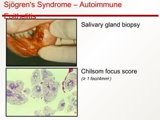 Sjögren's Syndrome – Autoimmune
Epithelitis
Salivary gland biopsy
Chilsom focus score
(≥ 1 foci/4mm2
)
 