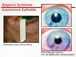Sjögren's Syndrome -
Autoimmune Epithelitis
Schirmer's test (≤5mm/5min)
Rose-Bengal staining
(≥4: van Bijsterveld’s scoring system)
 