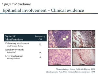 Sjögren’s Syndrome
Epithelial involvement – Clinical evidence
Systemic
Manifestations
Frequency
(%)
Pulmonary involvement
small airway disease
23
Renal involvement
interstitial 9
Liver involvement
billiary cirrhosis
4
Skopouli et al., Semin Arthritis Rheum 2000
Moutsopoulos HM. Clin Immunol Immunopathol. 1994
Labial Minor SG
Kidney Liver
Lung
 
