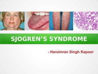 SJOGREN’S SYNDROME
- Harsimran Singh Kapoor
 