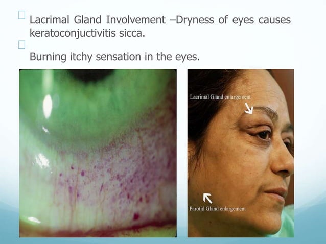 sjogren's syndrome clinical features,diagnosis,management | PPTX | Ear ...