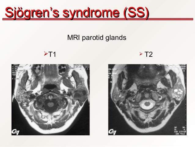 Sjogren's syndrome