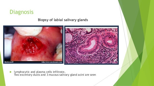 Sjogren syndrome, halitosis & treatment of osf Sjogren syndrome, halitosis & treatment of osf