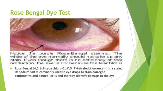 Sjogren syndrome, halitosis &amp; treatment of osf
