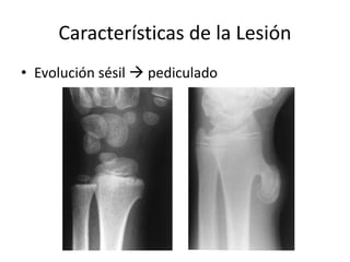 Características de la Lesión
• Evolución sésil  pediculado
 