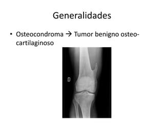 Generalidades
• Osteocondroma  Tumor benigno osteo-
cartilaginoso
 