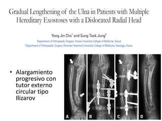 • Alargamiento
progresivo con
tutor externo
circular tipo
Ilizarov
 