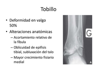 Tobillo
• Deformidad en valgo
50%
• Alteraciones anatómicas
– Acortamiento relativo de
la fíbula
– Oblicuidad de epifisis
tibial, subluxación del talo
– Mayor crecimiento fisiario
medial
 