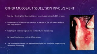 Ocular cicatricial pemphigoid, Stevens-Johnson Syndrome, Toxic ...