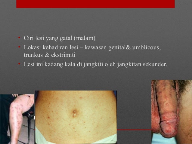 Ubat Gatal Hama - Warsiogx