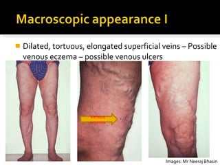 Dilated, tortuous, elongated superficial veins – Possible venous eczema – possible venous ulcers  Venous eczema Images: Mr Neeraj Bhasin 