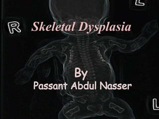 Skeletal Dysplasia
 