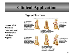 Clinical Application Types of Fractures green stick fissured comminuted transverse oblique spiral 
