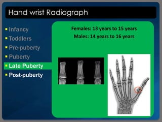 Hand wrist Radiograph
 Infancy
 Toddlers
 Pre-puberty
 Puberty
 Late Puberty
 Post-puberty
Females: 13 years to 15 years
Males: 14 years to 16 years
 