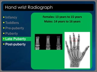 Hand wrist Radiograph
 Infancy
 Toddlers
 Pre-puberty
 Puberty
 Late Puberty
 Post-puberty
Females: 13 years to 15 years
Males: 14 years to 16 years
 