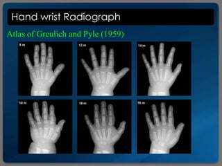 Hand wrist Radiograph
Atlas of Greulich and Pyle (1959)
 