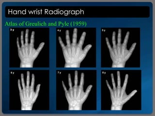 Hand wrist Radiograph
Atlas of Greulich and Pyle (1959)
 