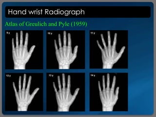 Hand wrist Radiograph
Atlas of Greulich and Pyle (1959)
 