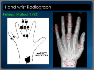 Hand wrist Radiograph
Fishman Method (1982)
 
