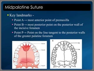 Midpalatine Suture
 Key landmarks -
 Point A→ most anterior point of premaxilla
 Point B→ most posterior point on the posterior wall of
the incisive foramen
 Point P→ Point on the line tangent to the posterior walls
of the greater palatine foramen
 