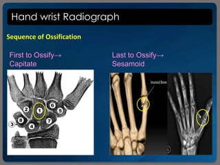 Hand wrist Radiograph
Sequence of Ossification
First to Ossify→
Capitate
Last to Ossify→
Sesamoid
 