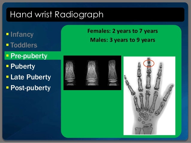 Bone Age Wrist Chart