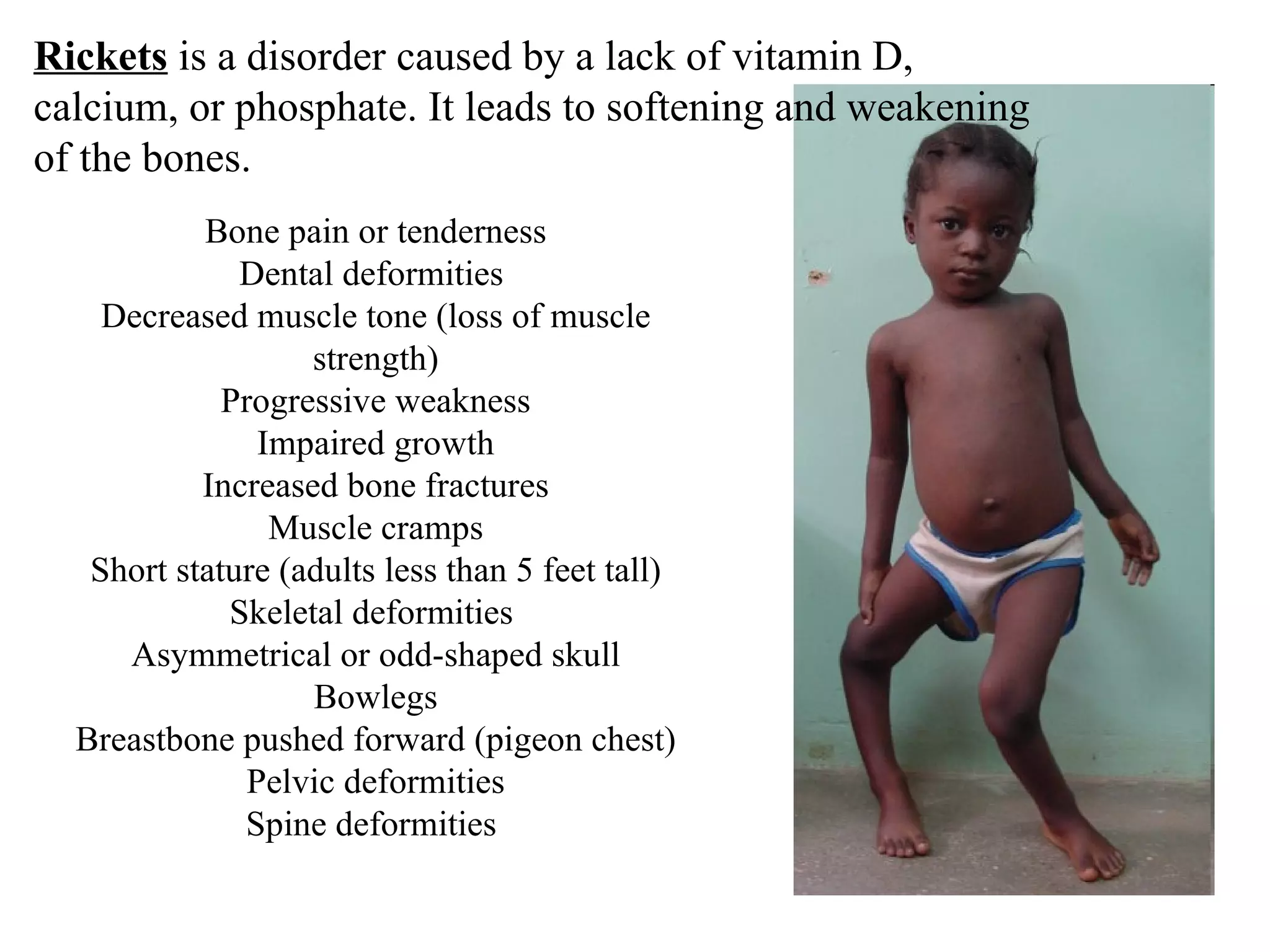 Rickets Graph Skeletal And Muscle Ppt | PPT