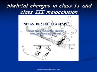 Skeletal changes in class II and
class III malocclusion
www.indiandentalacademy.com
INDIAN DENTAL ACADEMY
Leader in continuing dental education
www.indiandentalacademy.com
 