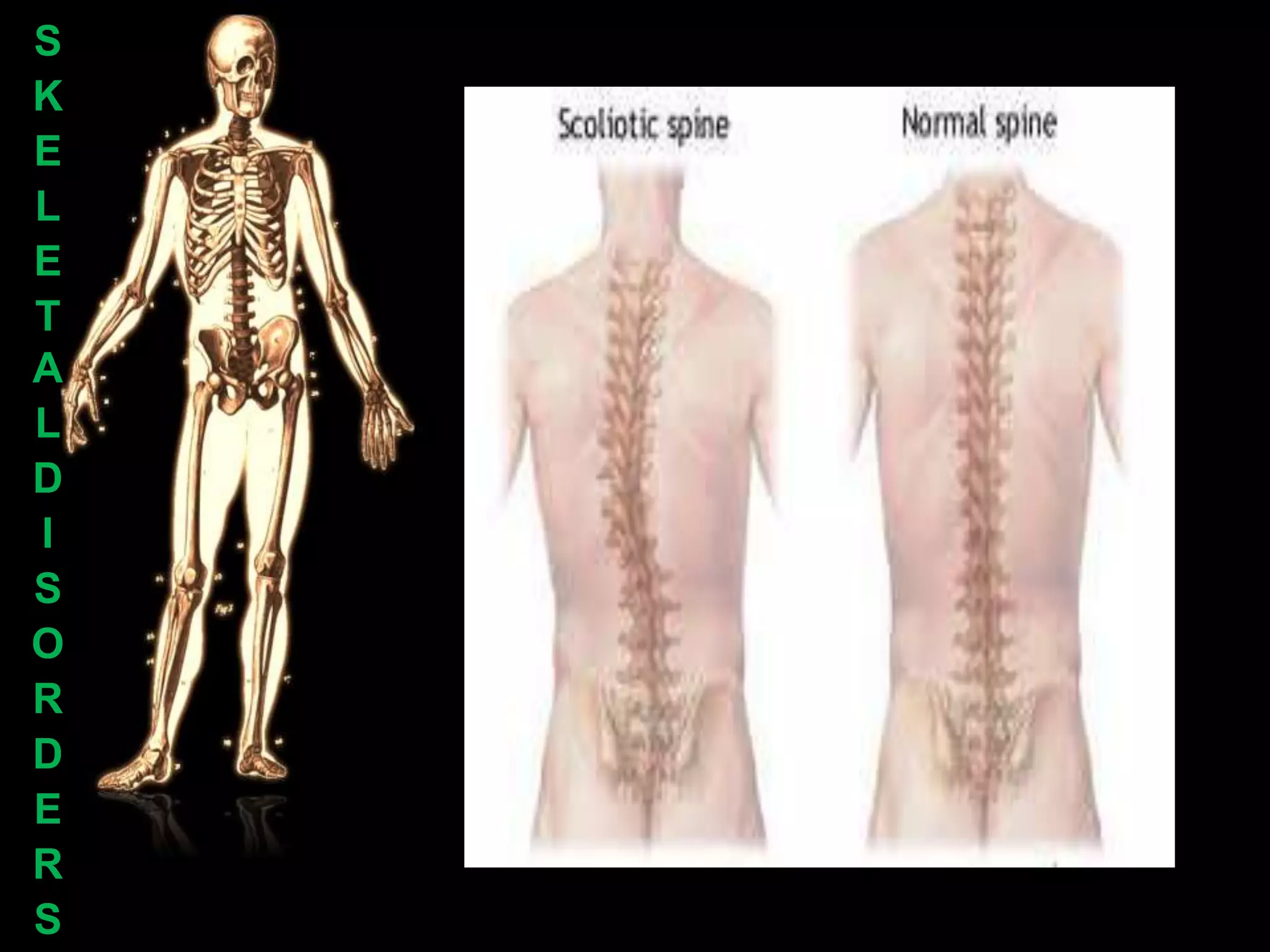 S
K
E
L
E
T
A
L
D
I
S
O
R
D
E
R
S
 